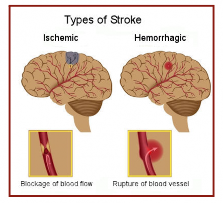 Data Science Analysis of Stroke Prediction - Exploratio Journal